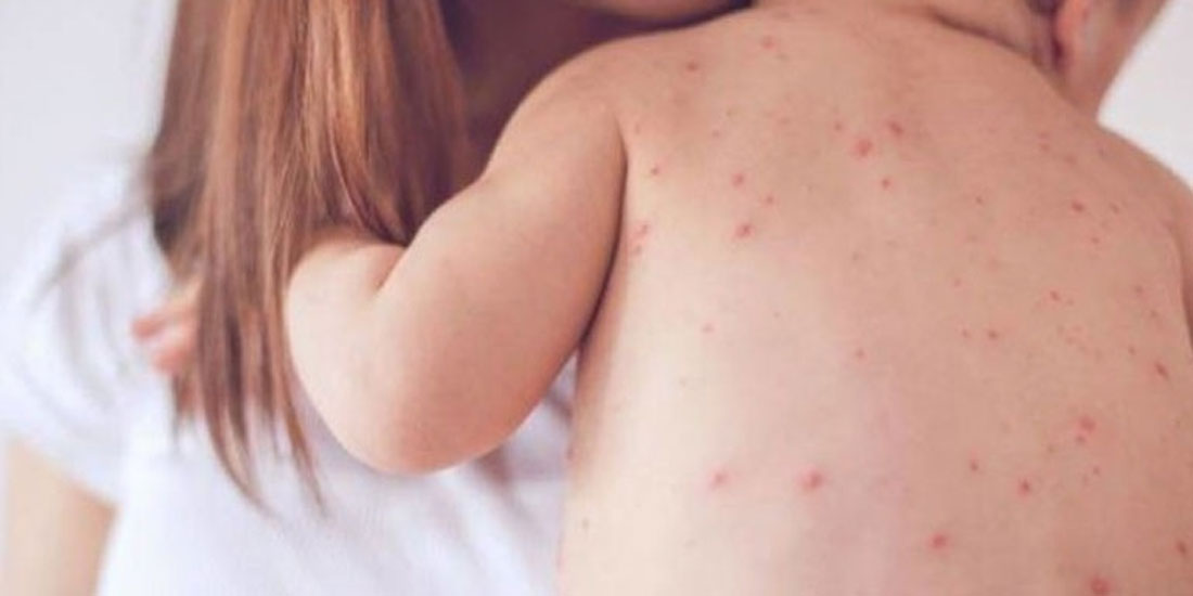 Υπερτριπλασιάστηκαν τα περιστατικά ιλαράς στην Ευρώπη το 2018 