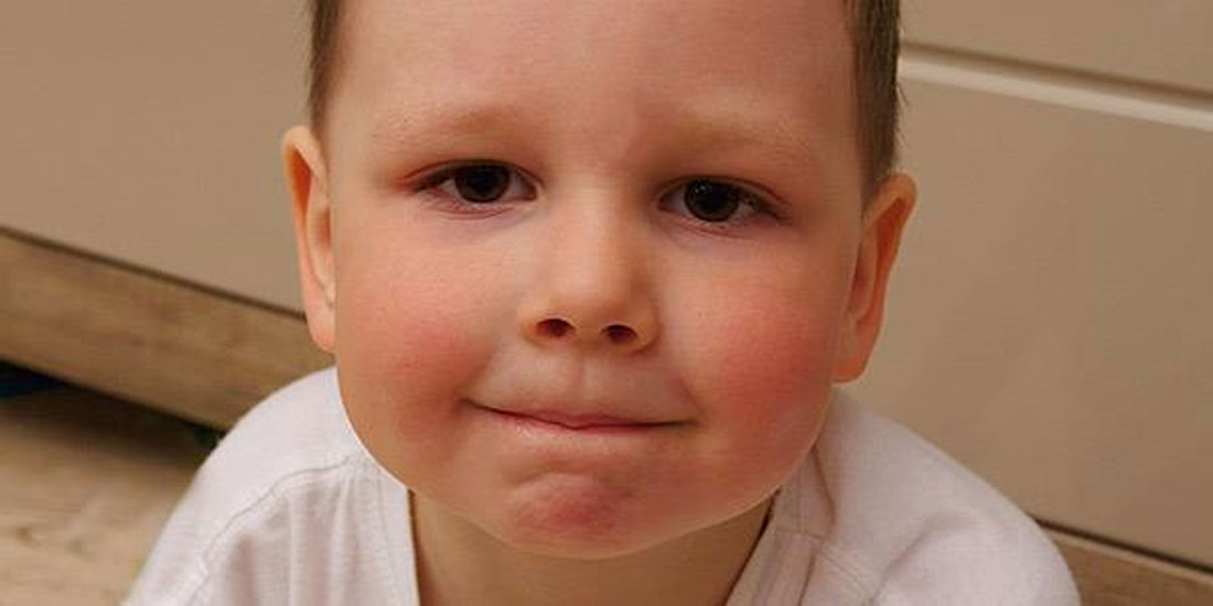 Θετικά αποτελέσματα θεραπείας σε παιδιά με Σοβαρή Ατοπική Δερματίτιδα