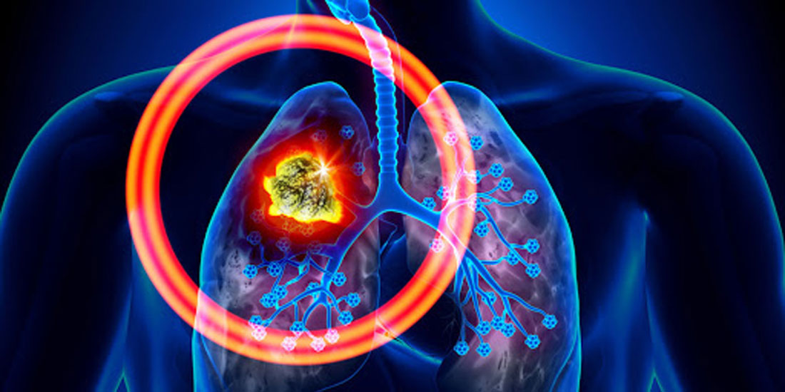 Θετική γνωμοδότηση της CHMP για έγκριση συνδυαστικής θεραπείας με χημειοθεραπεία για το μεταστατικό μη μικροκυτταρικό καρκίνο του πνεύμονα