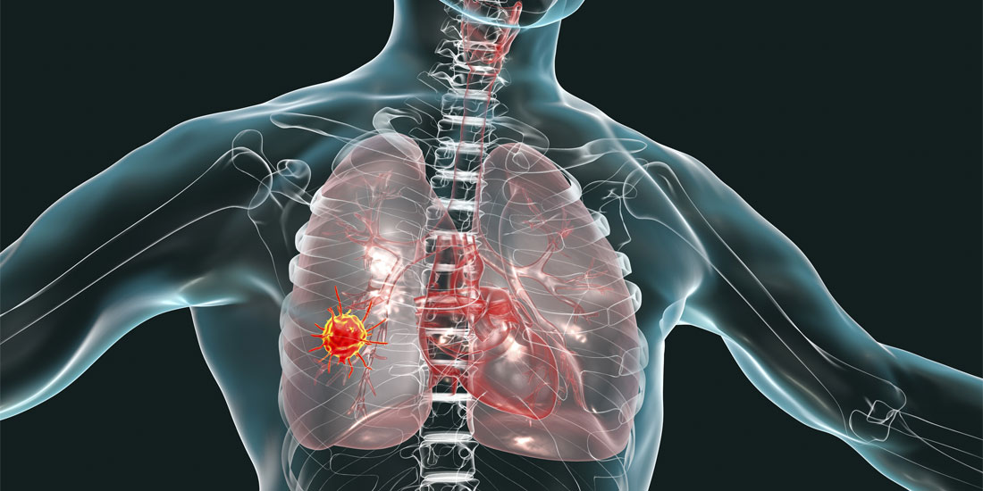 Με την πρώιμη διάγνωση του καρκίνου του πνεύμονα η  πενταετής επιβίωση αγγίζει το 92%