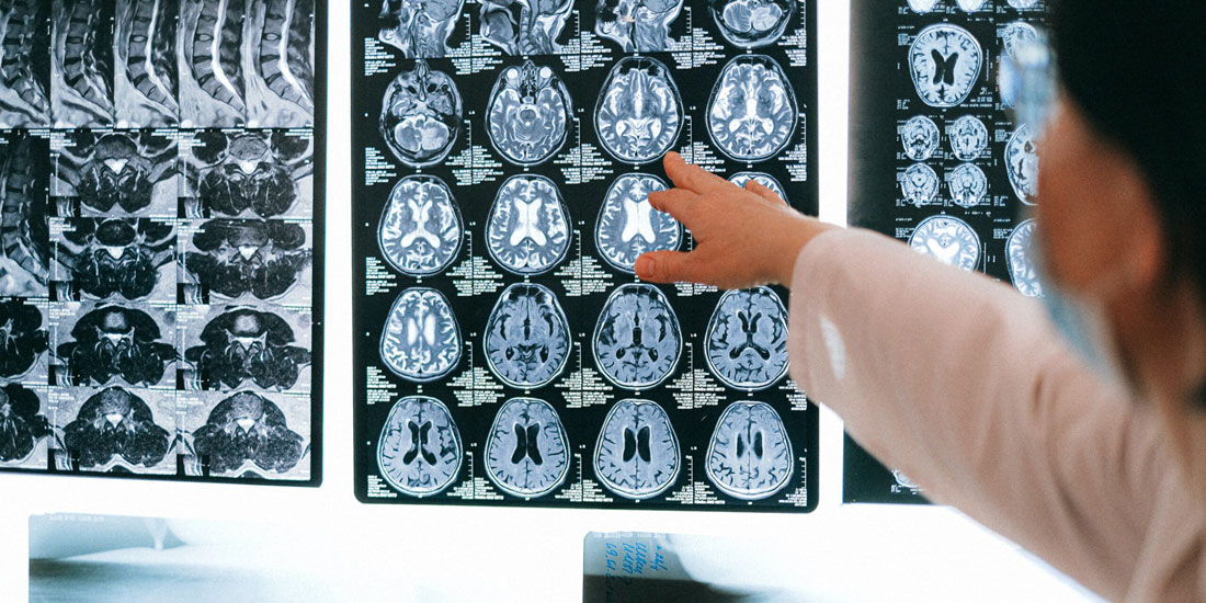 Μια μόνο μαγνητική εξέταση εγκεφάλου, με τη βοήθεια της τεχνητής νοημοσύνης, μπορεί να κάνει έγκαιρη διάγνωση της νόσου Αλτσχάιμερ