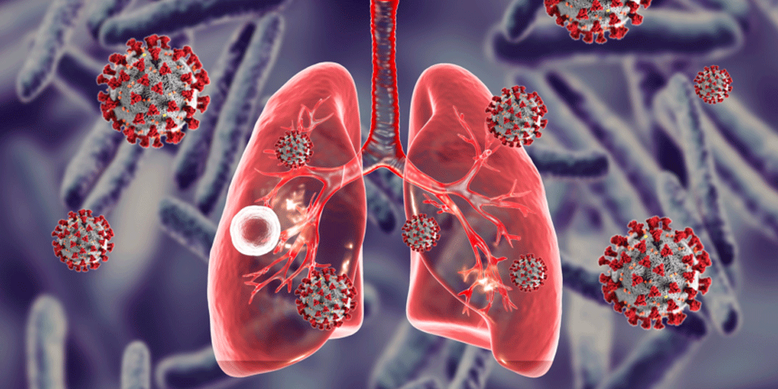 Φυματίωση: Η 2η αιτία θανάτου από λοιμώδες αίτιο μετά τη λοίμωξη COVID-19 παγκοσμίως