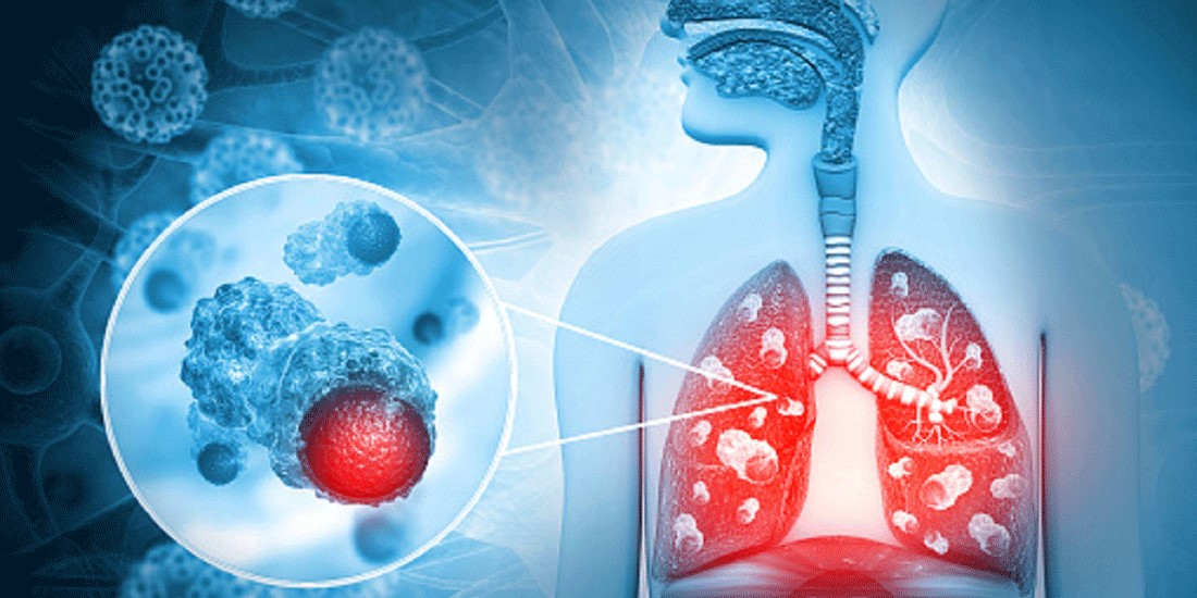 ΠΟΥ: Ο αριθμός των νεκρών από φυματίωση αυξάνεται στην Ευρώπη