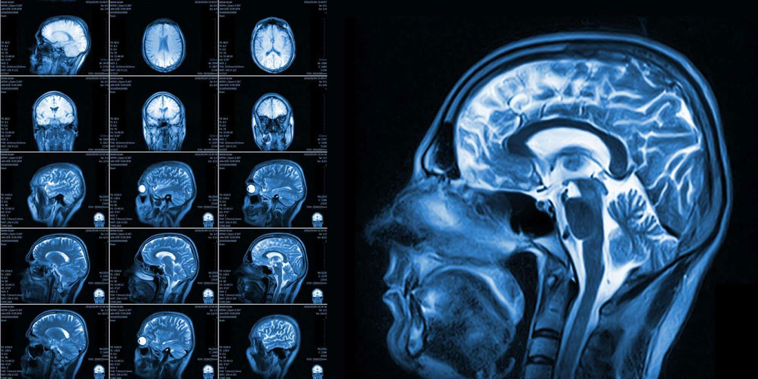 Τεχνική βαθιάς εγκεφαλικής διέγερσης αποκαθιστά λειτουργίες σε ασθενείς με εγκεφαλική βλάβη