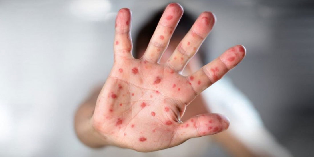 ΕΟΔΥ: Δράσεις αντιμετώπισης της επιδημικής έξαρσης κρουσμάτων ιλαράς