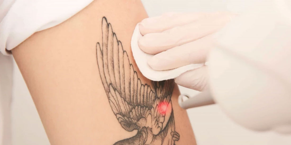 Αφαίρεση τατουάζ με Laser: Πόσες συνεδρίες απαιτούνται και ποιοι παράγοντες επηρεάζουν αρνητικά τη διαδικασία;