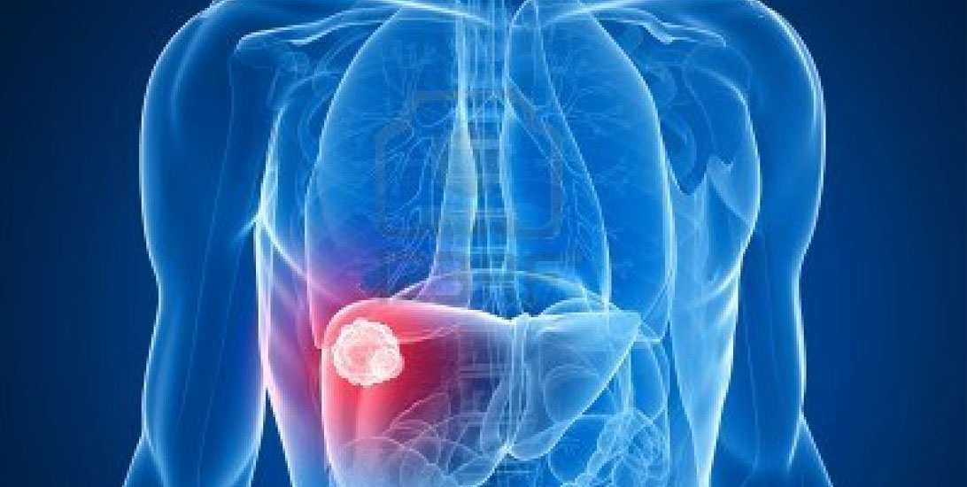 Ταχεία επανεξέταση της αίτησης της BMS για επέκταση της χρήσης του nivolumab  στον καρκίνο του ήπατος