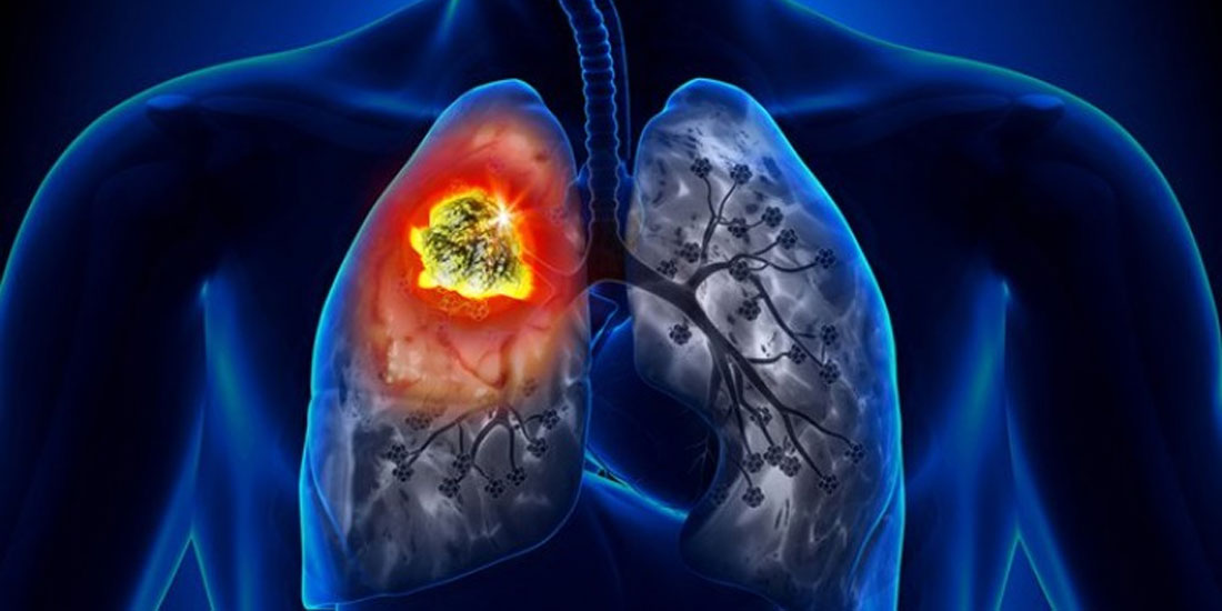 Συνδυαστική θεραπεία καταδεικνύει σημαντικό όφελος σε ασθενείς πρώτης γραμμής με μη μικροκυτταρικό καρκίνο του πνεύμονα