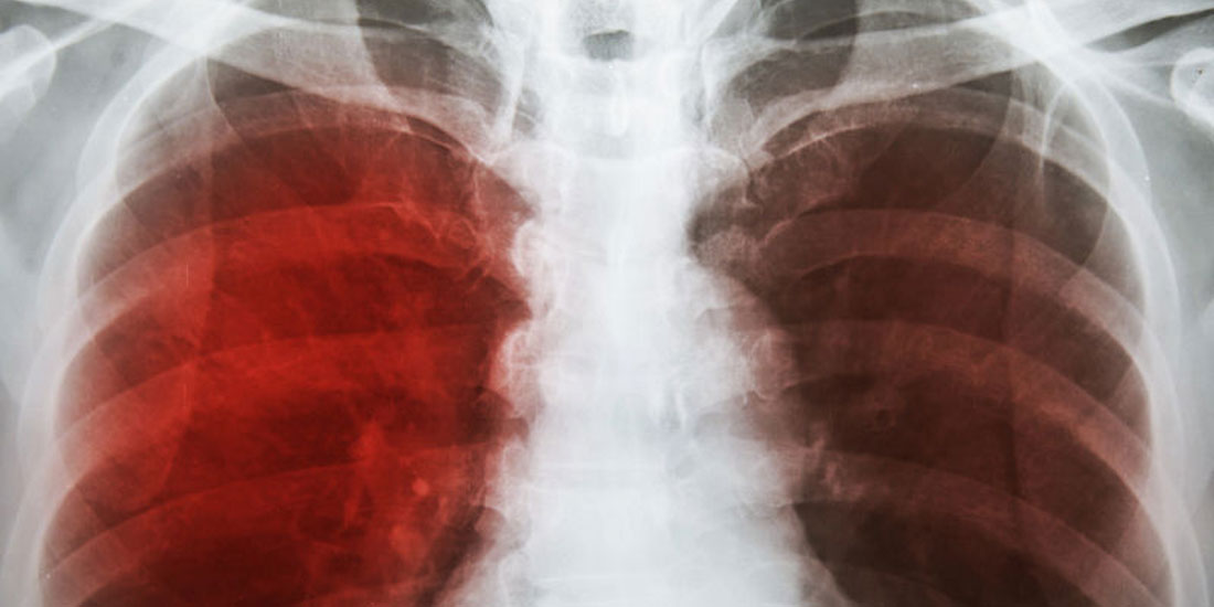 Κοινός στόχος να τεθεί στην «υγειονομική λήθη» η φυματίωση