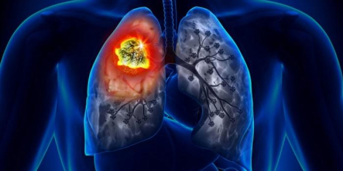 Pembrolizumab: Θετικά αποτελέσματα για τους ασθενείς με καρκίνο του πνεύμονα αλλά και έγκριση ως θεραπεία για το ουροθηλιακό καρκίνωμα