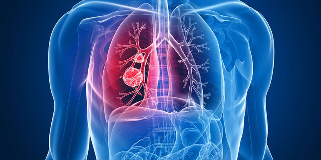 Θετική επίδραση ανοσοθεραπείας στη συνολική επιβίωση ασθενών με μη μικροκυτταρικό καρκίνο του πνεύμονα