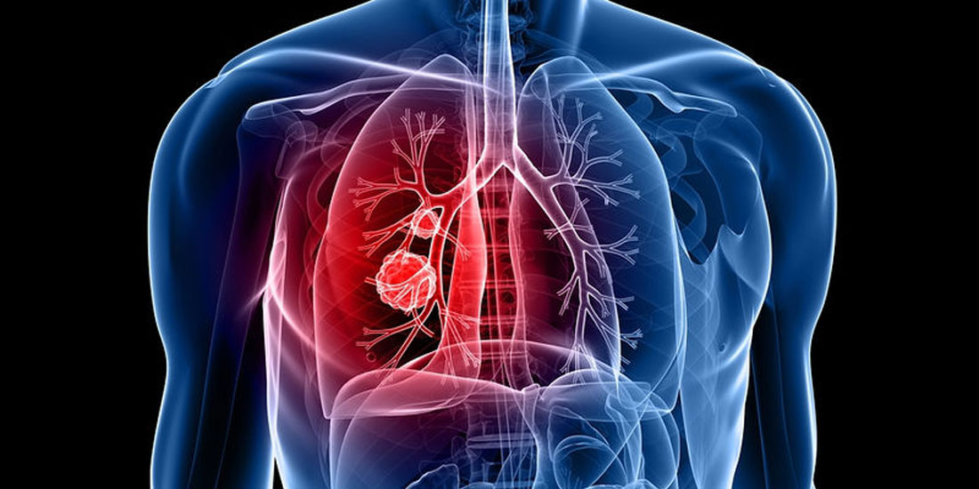 Σημαντικά οφέλη θεραπείας για ασθενείς με συγκεκριμένους μεταστατικούς τύπους καρκίνου του πνεύμονα