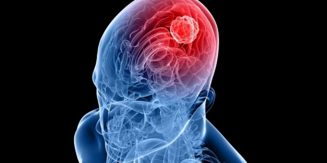 Οι γυναίκες αντιδρούν πιο καλά στη θεραπεία για καρκίνο του εγκεφάλου από ό,τι οι άνδρες